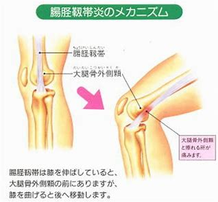 ランナー膝（腸脛靭帯炎）のメカニズム
